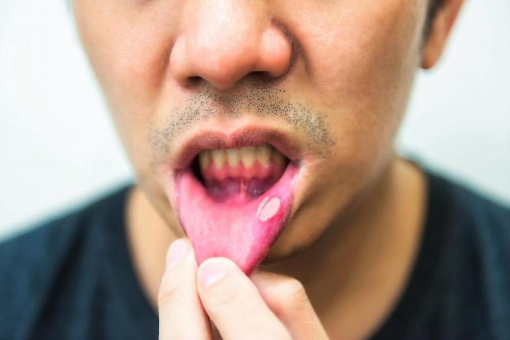 Mouth Ulcers