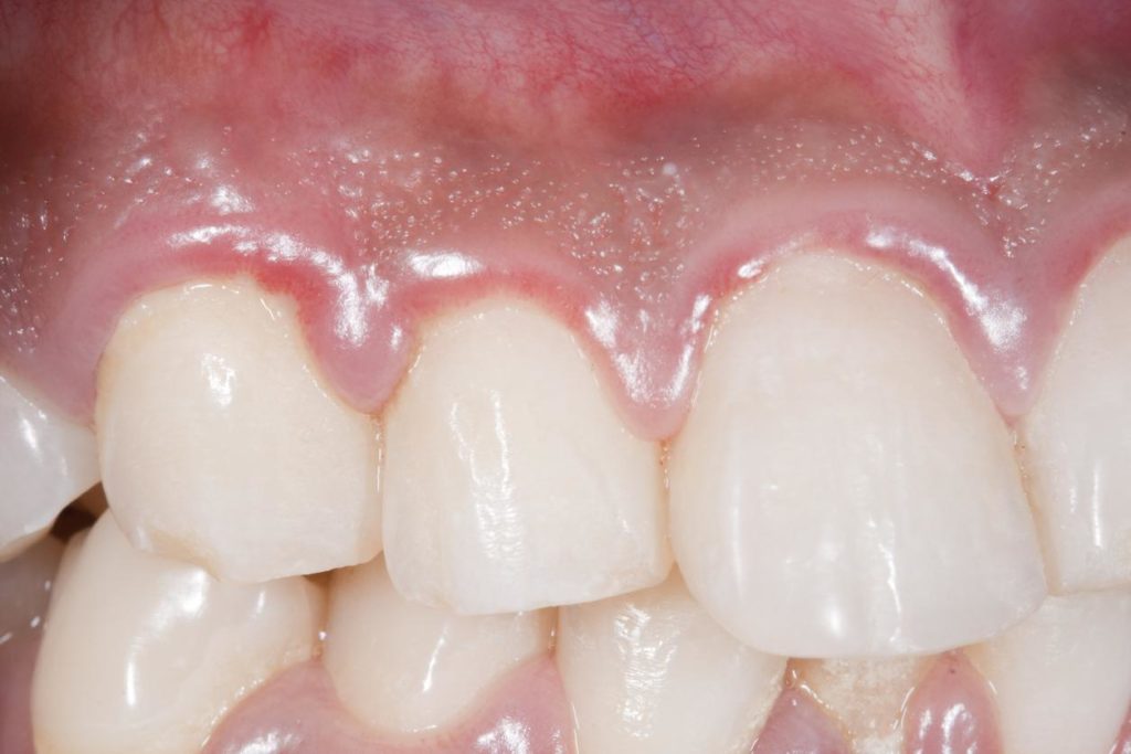 Symptoms of Common Dental Problems - Swollen Gums