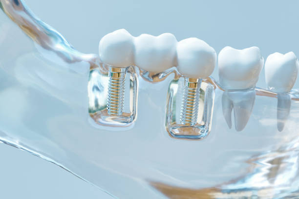 Dental Implants in Mundelein