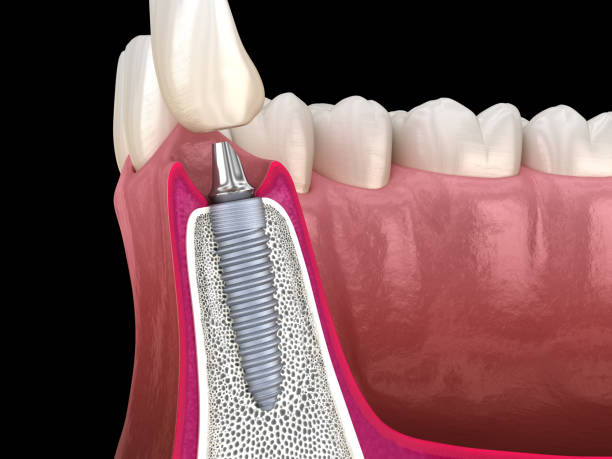 Dental Implant in Mundelein